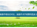抽脂手臂前后对比，抽脂手术手臂费用是多少