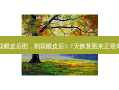 割双眼皮后图，割双眼皮后1-7天恢复图来正规奇致